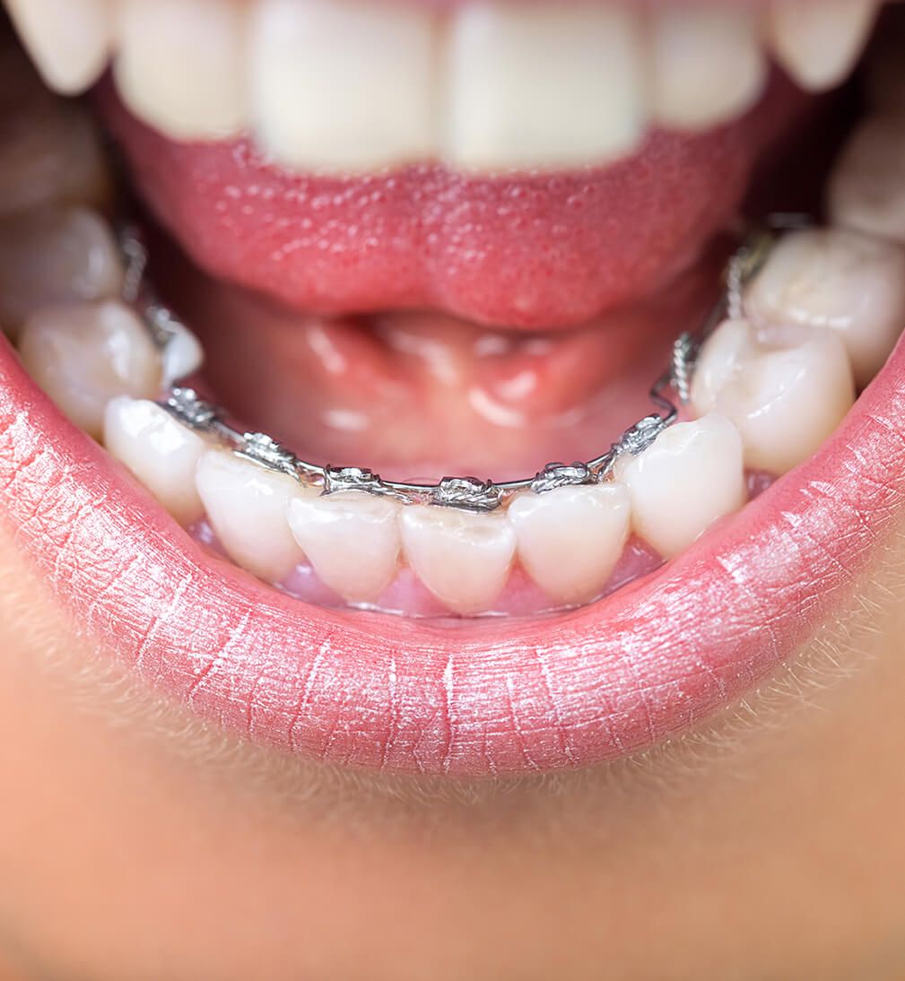Teeth with lingual braces