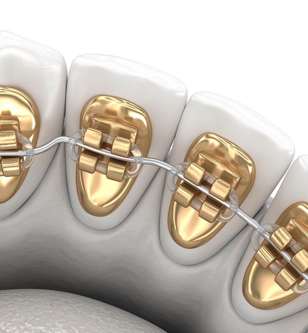Lingual Braces