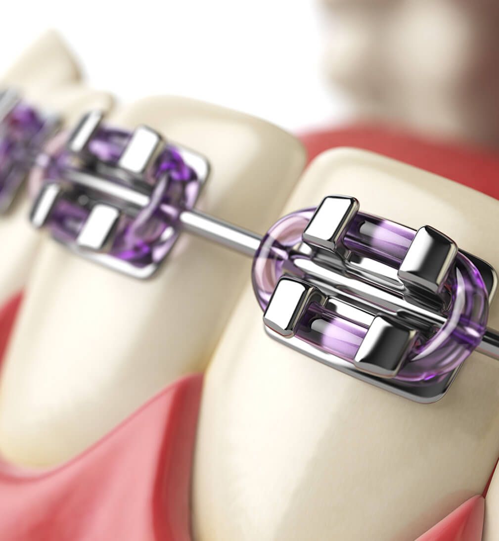 Metal Braces with purple bands