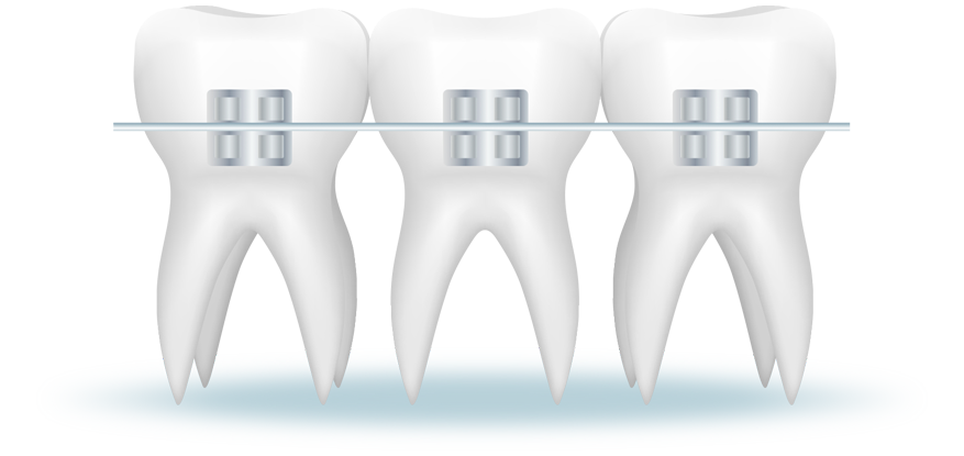 Non-Ligating Braces